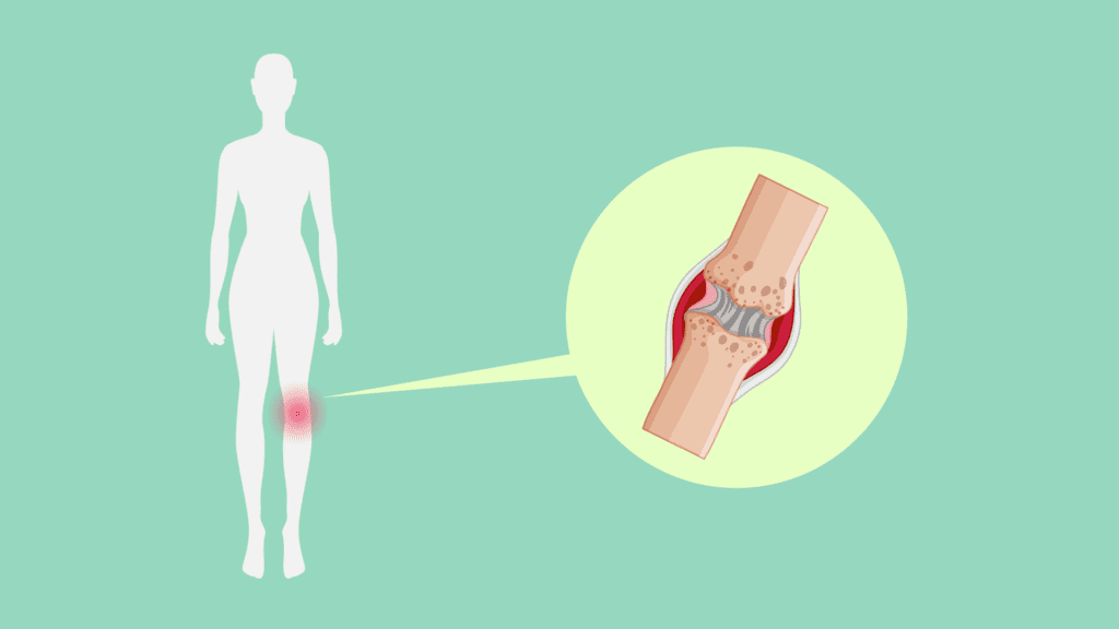 Artritis reumatoide, una malaltia autoimmune