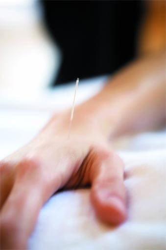La acupuntura en el dolor de hombro
