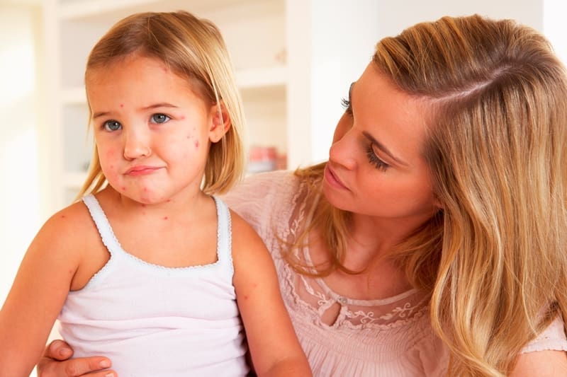 Consejos para tratar erupciones cutáneas en niños y bebés