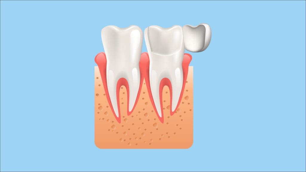 Tratamientos de estética dental: las carillas dentales