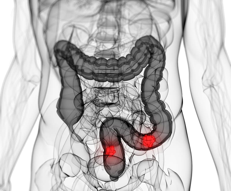Símptomes del càncer de colon. Descobreix-los i controla’ls